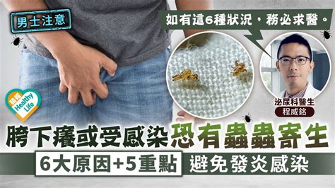 女生陰毛癢|外陰痕癢原因？下體痕癢分泌物有異味點算？10個外陰。